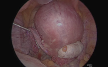 TLH全腹腔鏡下子宮全摘術