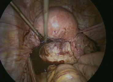 TLM 全腹腔鏡下子宮筋腫核出術