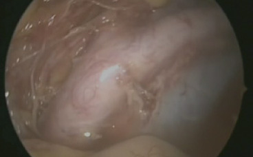 悪性腫瘍手術